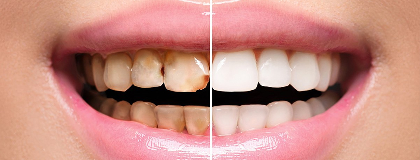 Cosmetic Dentistry Treatment