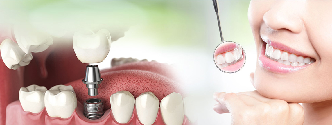 Dental implants Treatments